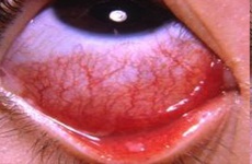 Điều trị viêm kết mạc (đau mắt đỏ) theo các phân loại bệnh và những lưu ý cần nhớ