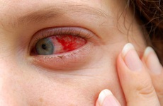 Điều trị biến chứng đau mắt đỏ: Tuyệt đối tuân thủ chỉ định của bác sĩ và không chủ quan