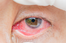 Phòng ngừa biến chứng đau mắt đỏ: Cẩn trọng trong việc tự điều trị và dùng thuốc!
