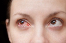 5 điều cần làm nếu nghi ngờ bị đau mắt đỏ, đặc biệt là điều số 3!