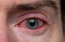 Bệnh viêm kết mạc kích ứng (đau mắt đỏ kích ứng) là gì? Những điều cần biết về viêm kết mạc kích ứng