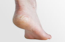 Nứt gót chân mùa hanh khô: Bệnh về da phổ biến nhưng không phải ai cũng biết cách đối phó