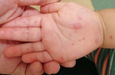 Trẻ bị tay chân miệng nhưng không sốt nguy hiểm như thế nào? Điểm danh những triệu chứng khác