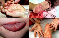 6 điều rất nhiều người đang hiểu sai về bệnh tay chân miệng 