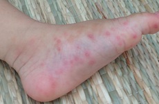 Phát ban dạng bỏng nước trên da ở bệnh tay chân miệng: Thời điểm xuất hiện, nguy cơ và cách xử trí