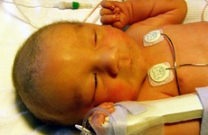 Tìm hiểu về bệnh xơ gan ở trẻ sơ sinh