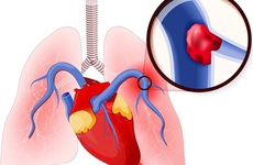 Những đối tượng có nguy cơ cao bị 'cục máu đông' gây nguy hiểm