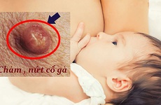 Cách chữa nứt cổ gà khi cho con bú mà mẹ cần biết