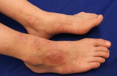 Các dạng viêm nhiễm da ở chân trong mùa mưa và cách phòng tránh