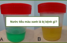 Đi ra nước tiểu màu xanh là bệnh gì?