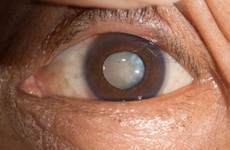 Biến chứng cận thị: Đục thủy tinh thể chưa phải biến chứng nguy hiểm hàng đầu
