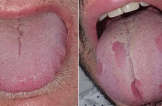 Nghiên cứu mới: Lưỡi bợt màu, sưng to, loét miệng có thể là dấu hiệu khác cảnh báo COVID-19