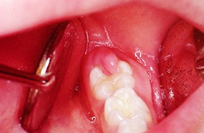 Tất tần tật thông tin từ A tới Z về sưng nướu răng