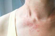 Những triệu chứng trên da của bệnh nhân Covid-19 có thể bạn chưa biết
