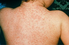 Chẩn đoán và xử lý kịp thời khi bị sốt phát ban do bệnh Rubella