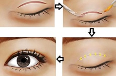 Cắt mí mắt: Hậu quả khôn lường và biện pháp khắc phục mí mắt bị lỗi, hỏng