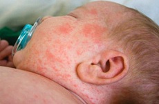 Trẻ bị sốt rubella cần làm gì? Dấu hiệu và cách xử lý như thế nào?