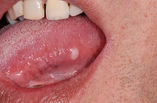 Ung thư lưỡi là gì? Tổng quan về căn bệnh ung thư lưỡi