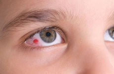 Mắt bị đỏ tròng trắng là gì? Những thông tin về mắt bị đỏ tròng trắng người bệnh nên biết