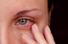 Đau mắt hột: Thông tin từ A đến Z về bệnh