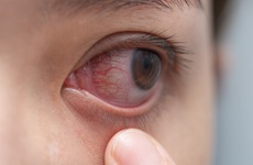Mắt bị nổi gân máu đỏ là bệnh gì? Có nguy hiểm không?