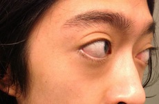 Bệnh mắt lồi: Nguyên nhân, triệu chứng và cách điều trị bệnh