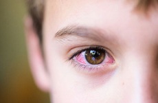 Mắt bị khô và mỏi: Nguyên nhân, biểu hiện và cách khắc phục