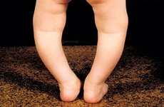 Chân trẻ sơ sinh bị cong: Nguyên nhân và phòng tránh bằng cách nào?