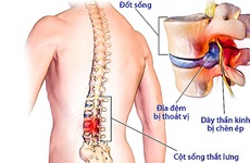 Thoát vị đĩa đệm có nên mổ hay không? Khi nào nên mổ?