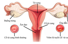 Viêm lộ tuyến cổ tử cung là gì? Những điều cần biết về bệnh viêm lộ tuyến cổ tử cung