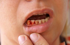 Chảy máu chân răng là bệnh gì? Những vấn đề xoay quanh tình trạng chảy máu chân răng
