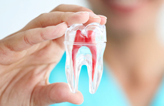 Tìm hiểu răng đã lấy tủy tồn tại được bao lâu?