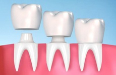 Bọc răng sứ có cần lấy tủy không? Quy trình bọc răng sứ sau khi lấy tủy