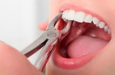 Biến chứng sau nhổ răng là gì? Những lưu ý trước và sau khi nhổ răng