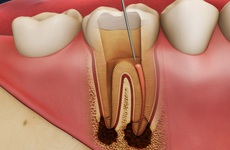Răng chết tủy phải làm sao? Điều trị răng chết tuỷ bằng cách nào?