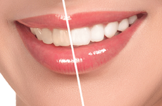 Có nên tẩy trắng răng không? Tẩy trắng răng có an toàn không?