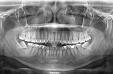 Tìm hiểu về chụp X quang răng và những điều cần lưu ý