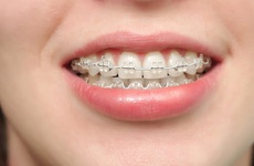 Tìm hiểu 4 bước trong quy trình niềng răng 