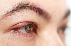 Làm cách nào để giảm sưng mắt khi bị dị ứng?