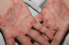 Nguyên nhân lòng bàn tay nổi đốm đỏ là gì? Cách điều trị như thế nào?