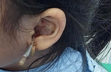 Từ vụ bé gái bị dị vật xuyên ống tai: Cách phát hiện và xử lý dị vật trong tai là gì?