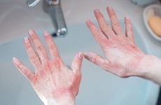 Phát ban do rửa tay: 5 nguyên nhân cần chú ý