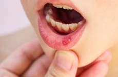 Chuyên gia chia sẻ cách chăm sóc cho trẻ khi bị nhiệt miệng