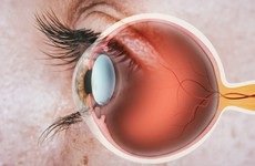 Đau hốc mắt là bị gì? Đau hốc mắt có phải bị viêm xoang không?