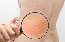 Giao mùa bị nổi mề đay nên làm gì để giảm ngứa mề đay nhanh tại nhà?