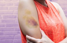 Chân tay dễ bị bầm tím do đâu? Da bị bầm tím thiếu chất gì?