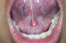 Sỏi tuyến nước bọt dưới lưỡi: Nguyên nhân, triệu chứng và cách điều trị