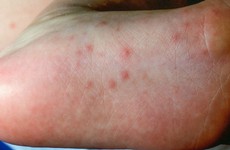 7 bệnh gây phát ban, mẩn ngứa da do virus cần lưu ý trong mùa này