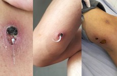 Giun rồng là giun gì? Bệnh giun rồng có chữa khỏi được không?