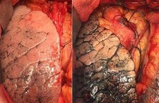 Cách phát hiện sớm bệnh ung thư phổi